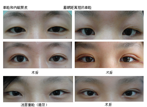 北京中日友好马海欢割双眼皮案例图