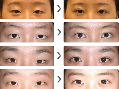 北京同仁医院郑永生双眼皮案例