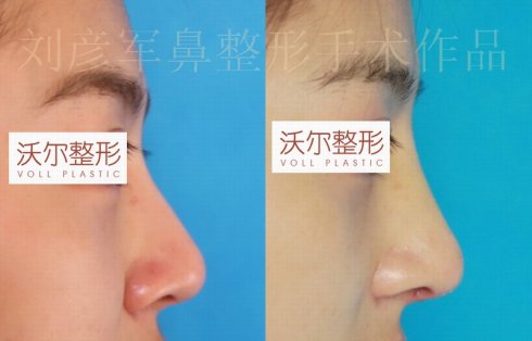 刘彦军隆鼻案例