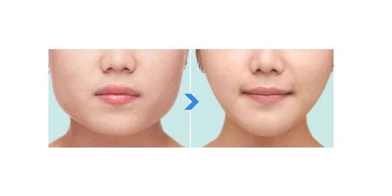 北京同仁医院马涛双眼皮案例