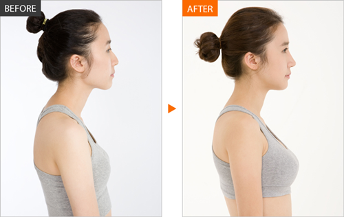 上海长征医院江华隆胸案例