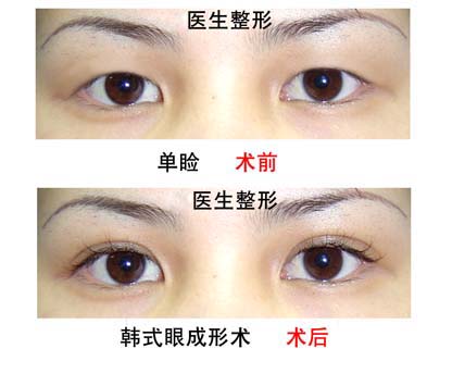 上海长征医院林子豪双眼皮案例