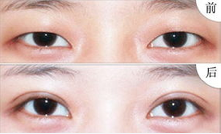 上海长征医院袁湘斌双眼皮案例