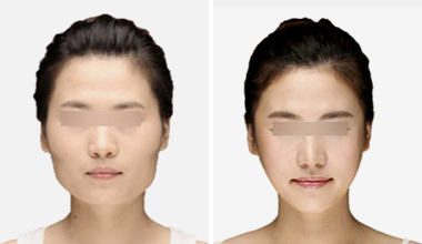 上海长征医院章建林下颌角磨骨案例