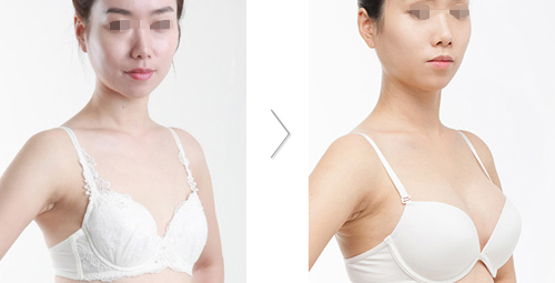 上海长征医院朱晓海隆胸案例