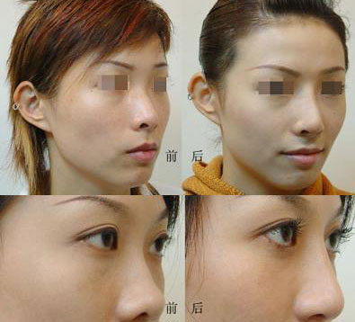 上海长征医院张盈帆隆鼻案例图