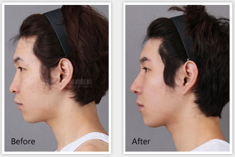 上海华美谢卫国隆鼻案例图