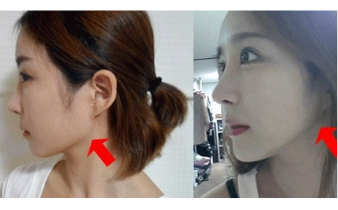 上海华美整形医院李志海磨骨案例图