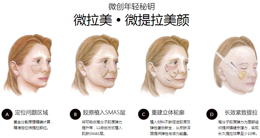 上海华美整形医院韩胜除皱技术