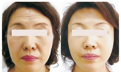 上海华美韩胜面部除皱案例图