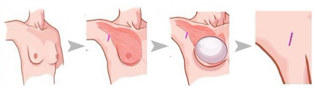 上海华美叶丽萍假体隆胸