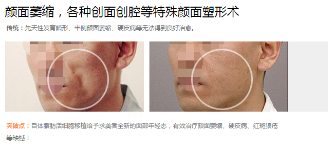 北京煤炭总医院雷华面部整形 北京煤炭总医院雷华面部整形