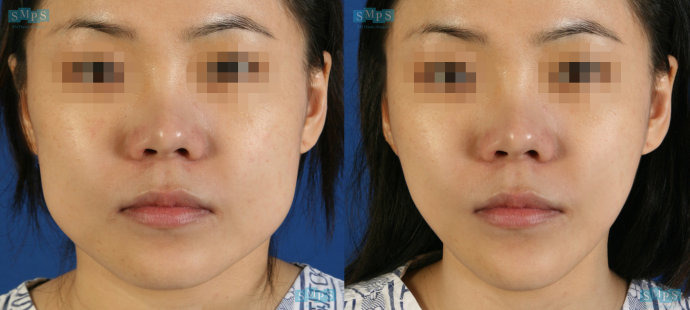 北京二炮总医院罗金超下颌角磨骨案例 北京二炮总医院罗金超下颌角磨骨案例