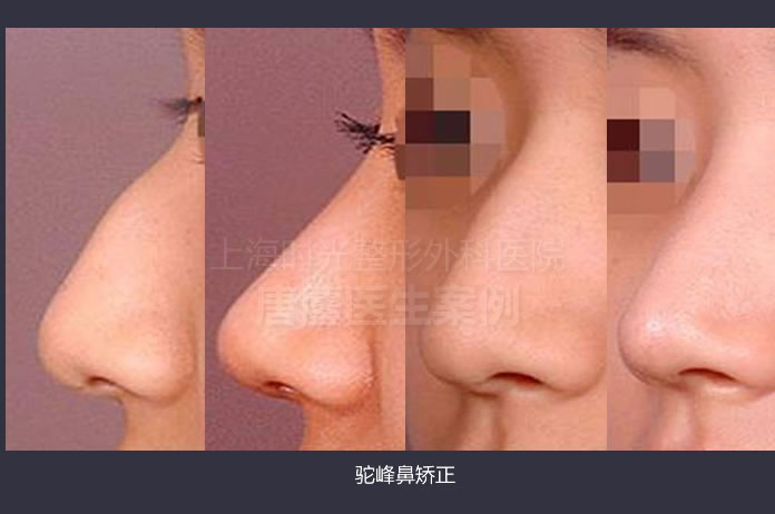 上海时光唐鏖隆鼻案例图 上海时光唐鏖隆鼻案例图