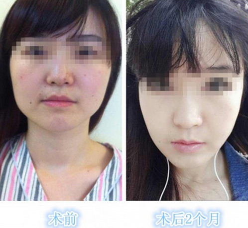 上海名航俞良钢磨颧骨案例图 上海名航俞良钢磨颧骨案例图